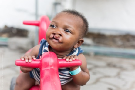 Paul Pascal after going through the Infant Feeding Program and just before receiving surgery to have his cleft lip repaired.